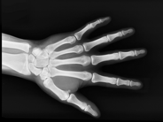 La determinación de la edad no puede aplicarse de forma indiscriminada